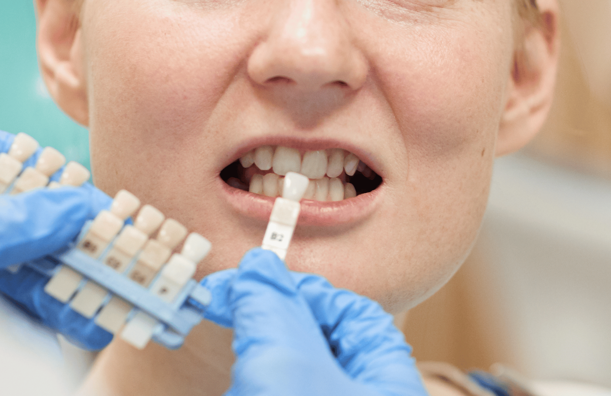Dental Crown