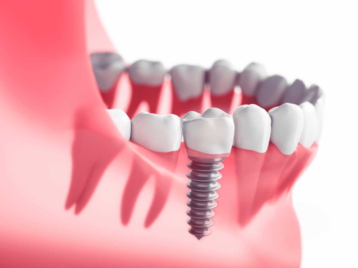 Dental implement