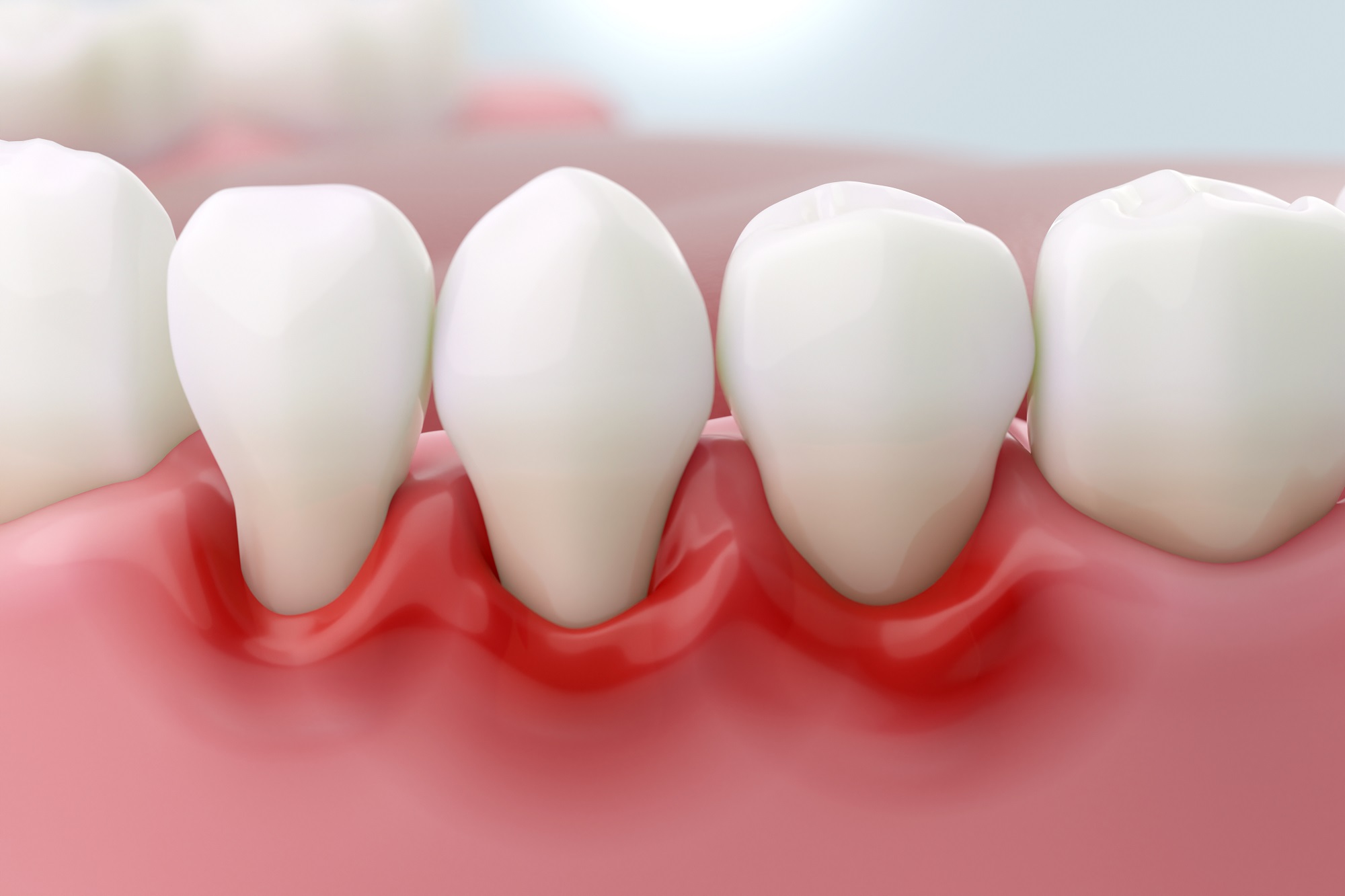 Gum disease and inflammation from Periodontitis