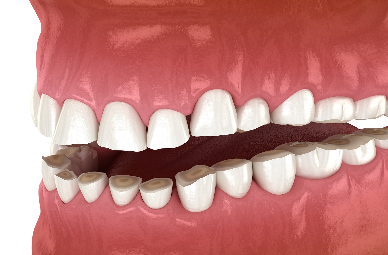 Dental attrition