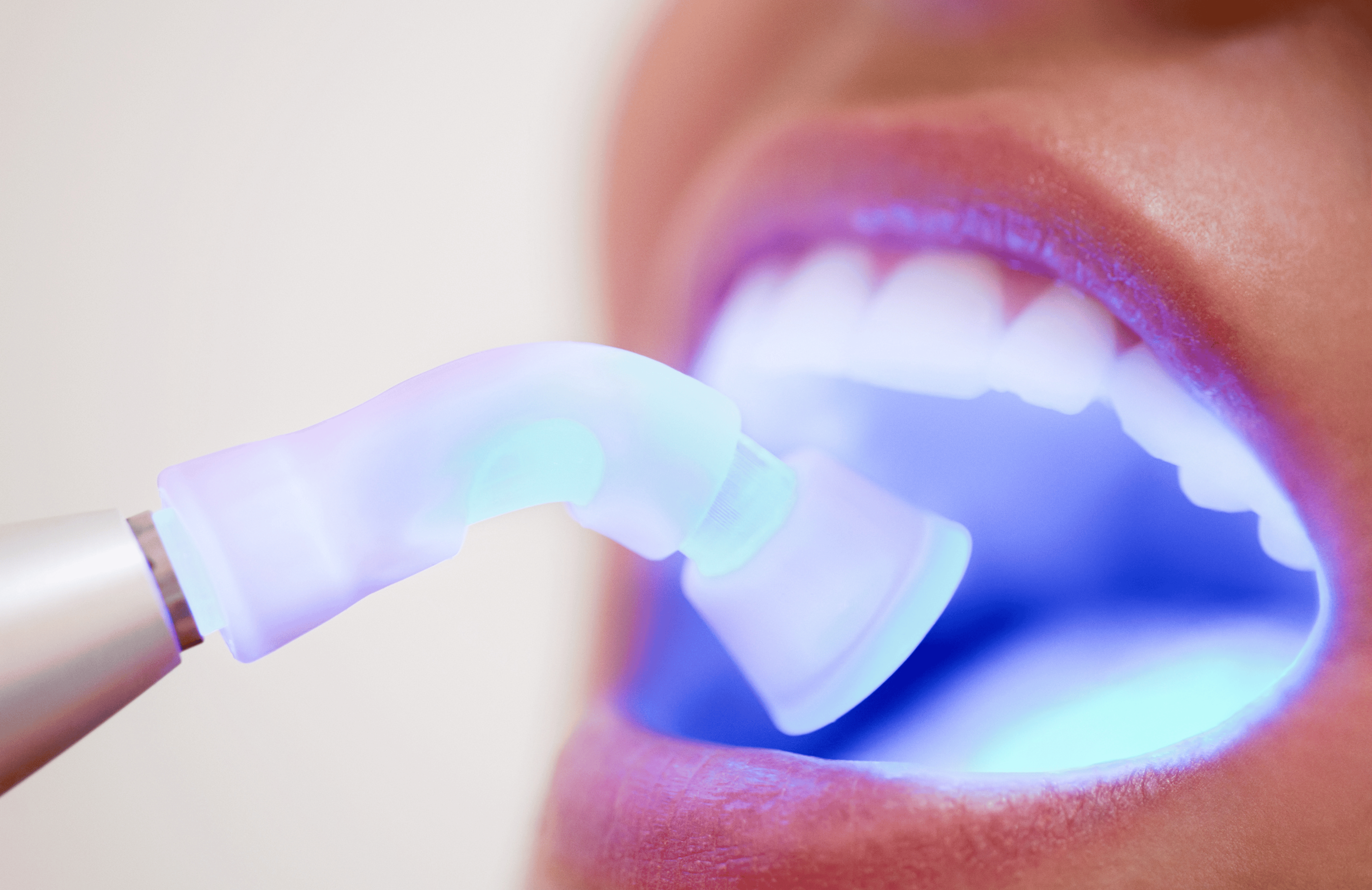 White Fillings