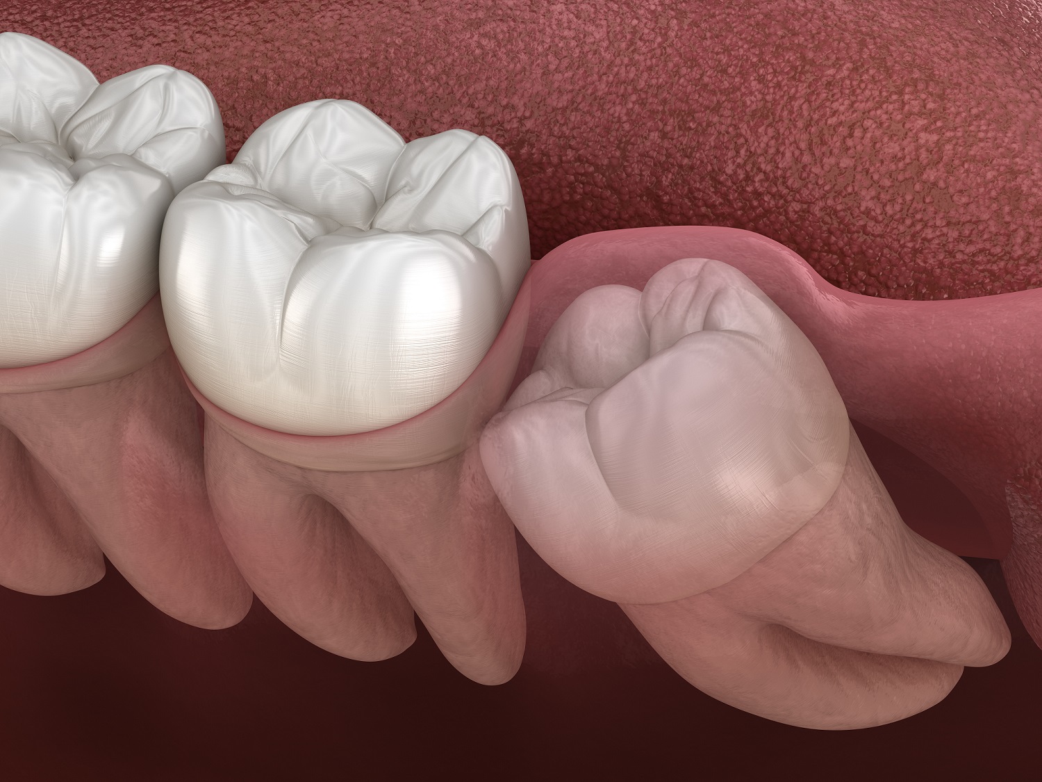 Healthy teeth and wisdom tooth