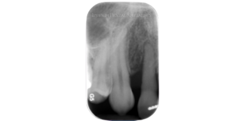 After Non-Surgical Periodontal Treatment 1