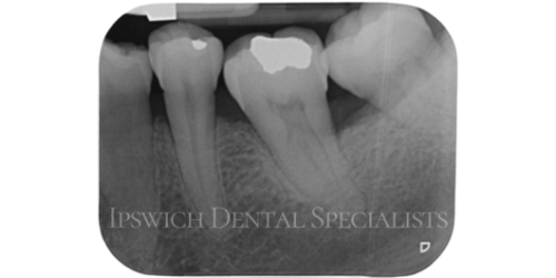 After Non-Surgical Periodontal Treatment 2