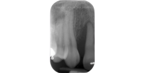 Before Non-Surgical Periodontal Treatment 1