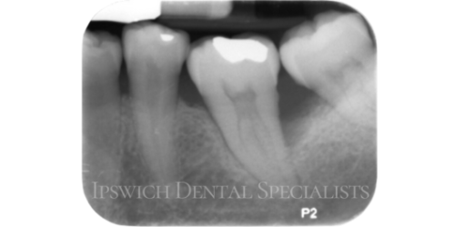 Before Non-Surgical Periodontal Treatment 2