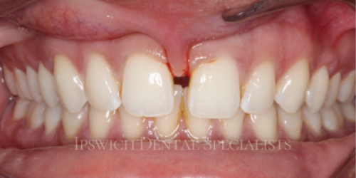 Frenectomy_Before_1