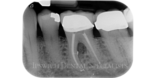 Lower Molar Lateral Canal Furcallesion After 1