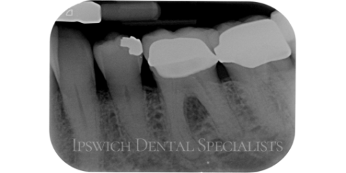 Lower Molar Lateral Canal Furcallesion Before 1