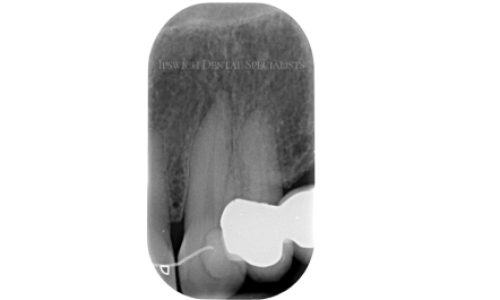 Maxillary_Canine_LateralCanal_Before_1