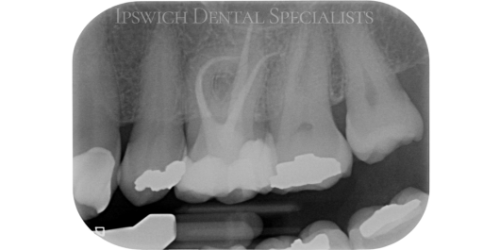 Severely_Curved_Maxillary_Molar_After_1