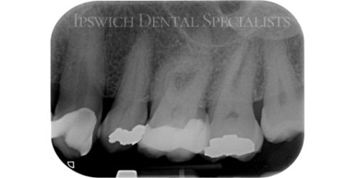 Severely_Curved_Maxillary_Molar_Before_1