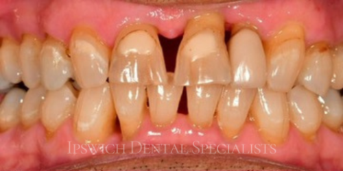 Veneer Before 1